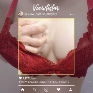 [Breast Augmentation (Motiva)] Hong Eunseo | Plastic Surgery Korea