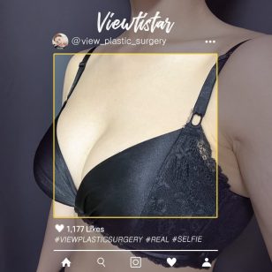 [Breast Augmentation (Motiva)] Yoo Heyri | Plastic Surgery Korea
