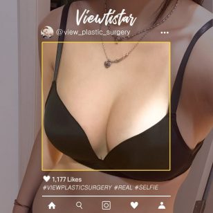 [Breast Augmentation (Motiva)] Kang Seungyeon | Plastic Surgery Korea