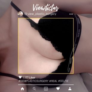 [Breast Augmentation (Mentor Extra)] Kang Minji | Plastic Surgery Korea