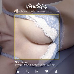 [Breast Augmentation (Motiva)] Kim Minkyung | Plastic Surgery Korea