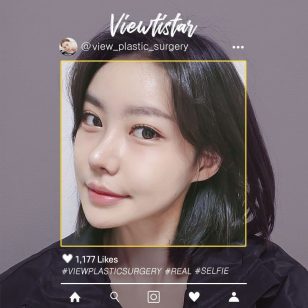 [2 Types Facial Contouring + Pyriform Augmentation + Revision Rhinoplasty] Lee Yuna | Plastic Surgery Korea