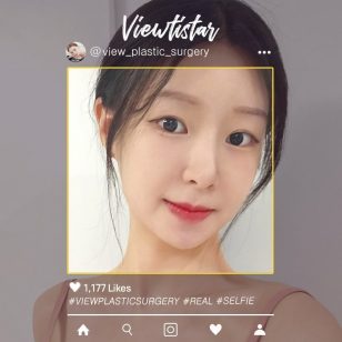 [3 Types Facial Contouring + Rhinoplasty + Fat Graft(Smile lines, Forehead, Temples)] Park Sooyeon | Plastic Surgery Korea