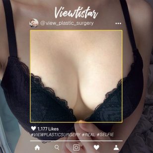 [Breast Augmentation (Motiva)] Kim Seeun | Plastic Surgery Korea