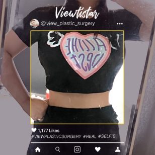 [Liposuction (Abdomen, Back)] Lee Heejin | Plastic Surgery Korea