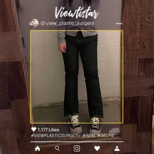 [Liposuction (Lower Body)] Lee Heejin | Plastic Surgery Korea