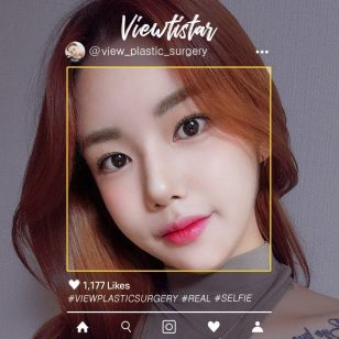 [3 Types Facial Contouring+Fat Graft] Kim Heesun | Plastic Surgery Korea