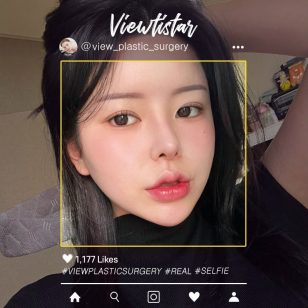 [Double Eyelid Surgery+Rhinoplasty+Fat Graft+Face Liposuction] Kang Yooseon | Plastic Surgery Korea