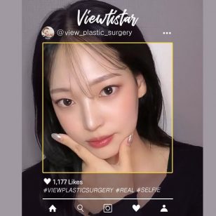 [Rhinoplasty] Seo Jinyoung | Plastic Surgery Korea