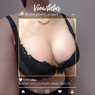 [Breast Augmentation (Motiva)] Jung Minju | Plastic Surgery Korea