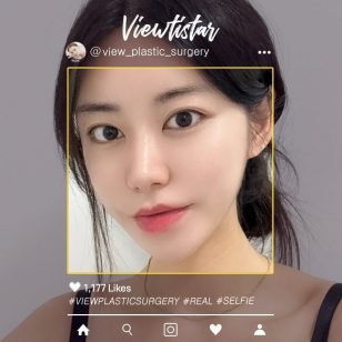 [Under Eye Fat Reposition, Face Liposuction(Double chin, Cheeks, Jawline)] Joe Yeseul | Plastic Surgery Korea