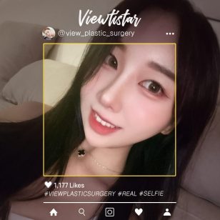 [Canthoplasty (Epicanthoplasty, Lateral Canthoplasty, Lateral Hotz Canthoplasty)] Seo seryeong | Plastic Surgery Korea