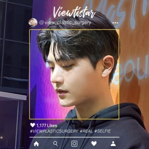 [Rhinoplasty] Kim Minseo | Plastic Surgery Korea