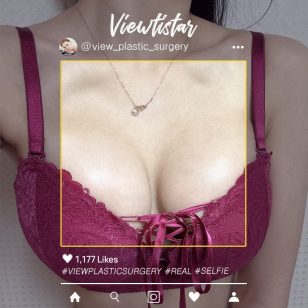 [Breast Augmentation (Sebbin)] Lee hyeri | Plastic Surgery Korea