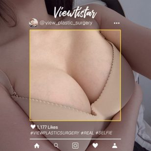 [Breast Augmentation (Motiva)] Joe Yeseul | Plastic Surgery Korea