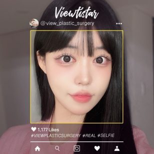 [Double Eyelid Surgery+Thread Lift+Face Liposuction+Fat Graft] Park Sehee | Plastic Surgery Korea