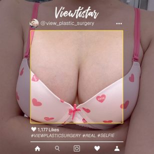 [Breast Augmentation (Mentor boost)] Jeon Soyeon | Plastic Surgery Korea