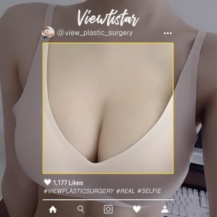 [Brest Augmentation (Mentor Xtra)] Kim Hawon | Plastic Surgery Korea